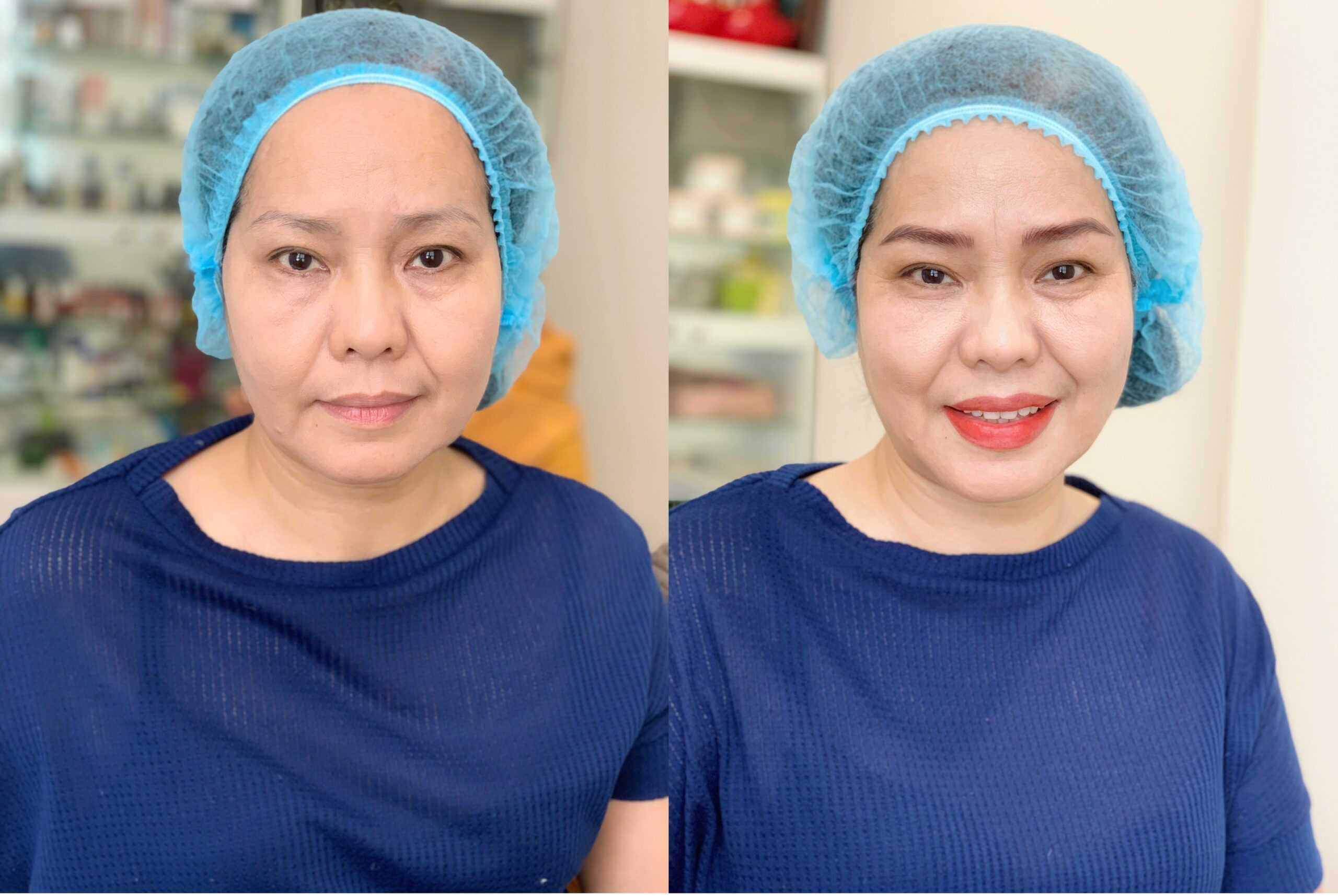 Cô Chi trước và sau khi Hairstroke chân mày và phun môi Collagen