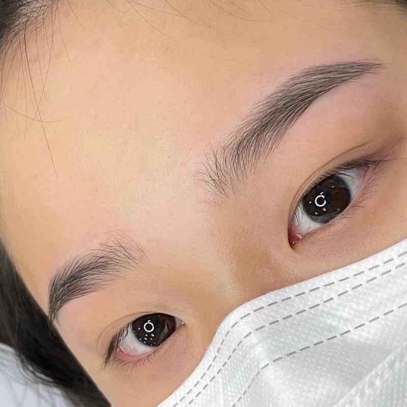 Sẹo khiến vùng da chân mày bị chảy xệ