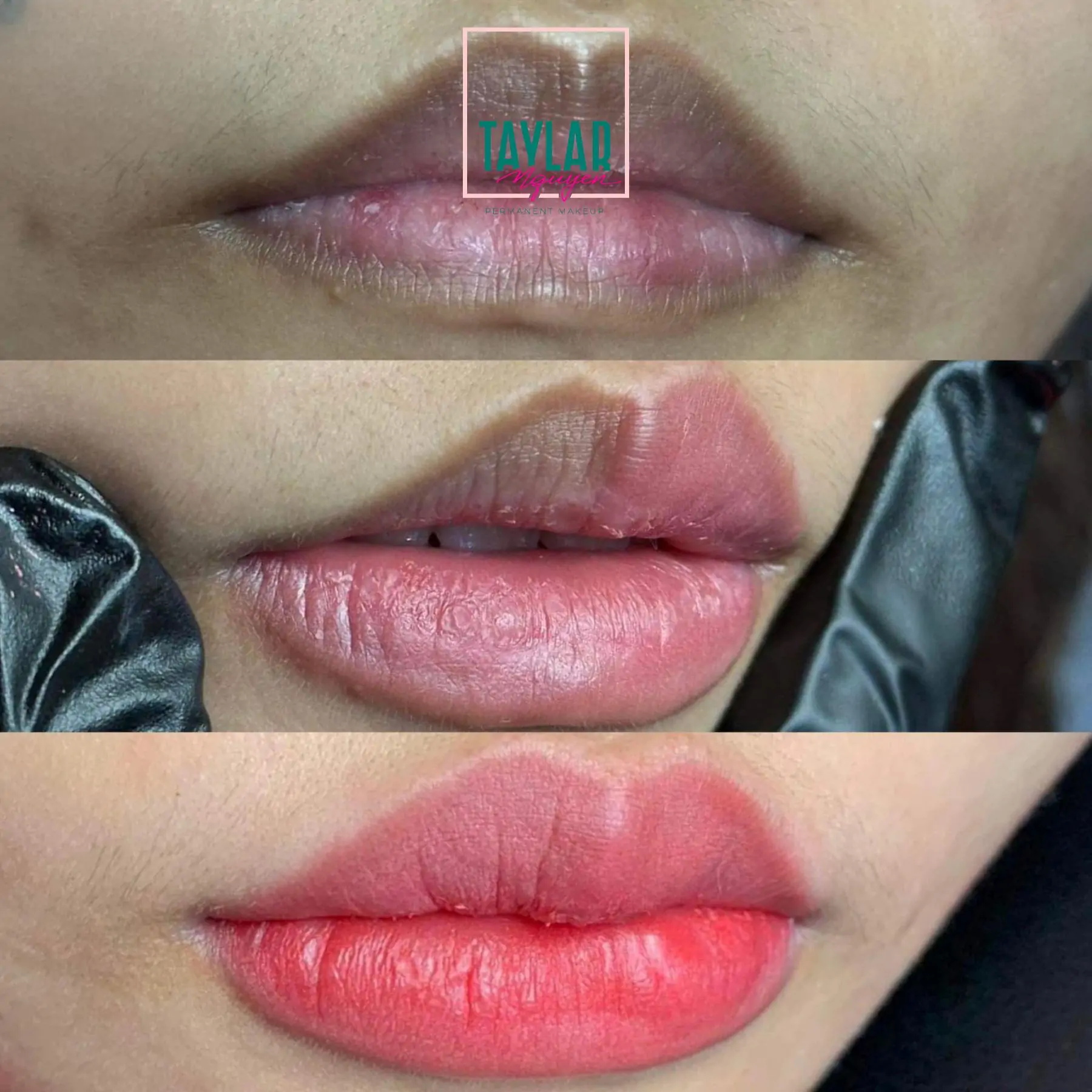 Hình ảnh trước và sau khi phun môi Collagen