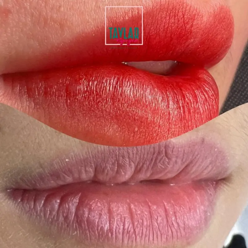 Kỹ thuật phun môi Collagen khắc phục nhược điểm của đôi môi thâm xỉn