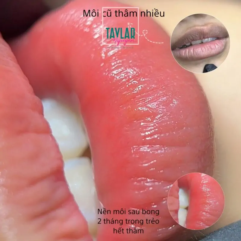 Phun môi Collagen phù hợp với ai