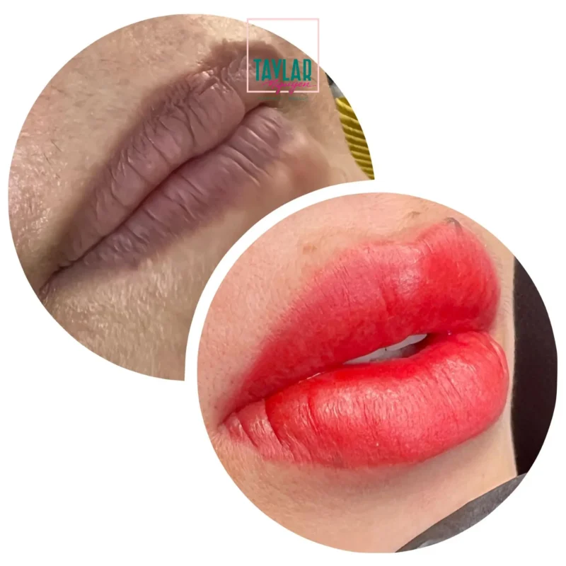 Hình ảnh khách hàng trước và sau khi thực hiện phun xăm môi Plasma