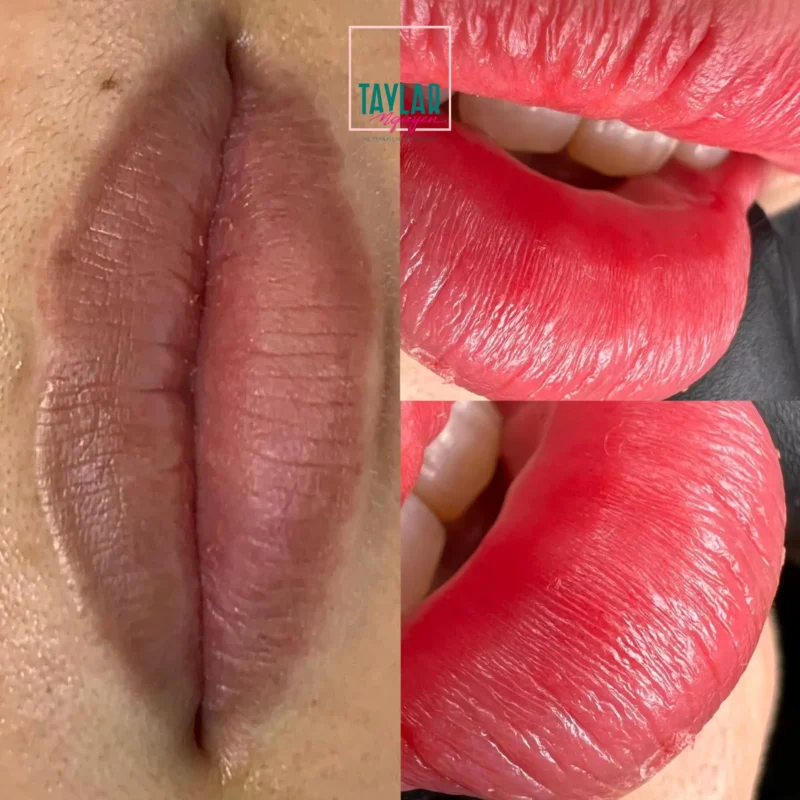 Phun môi Plasma giúp trẻ hóa ngược đôi môi lão hóa và khô ráp