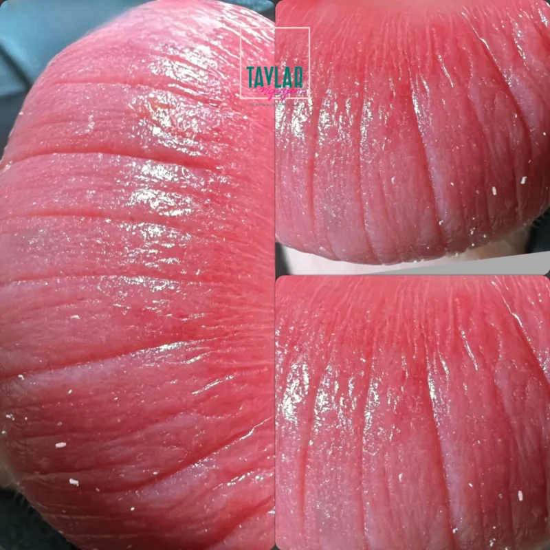 Cấy môi công nghệ sinh học khắc phục hoàn toàn mọi khuyết điểm môi của khách hàng