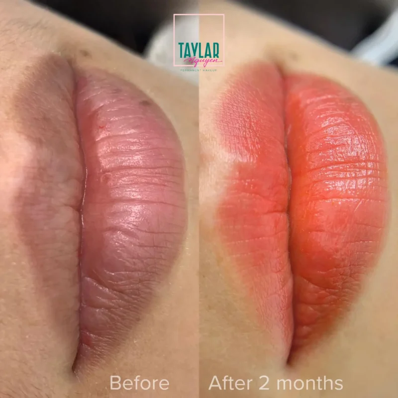 Phương pháp phun môi Collagen này giúp cải thiện sắc tố môi