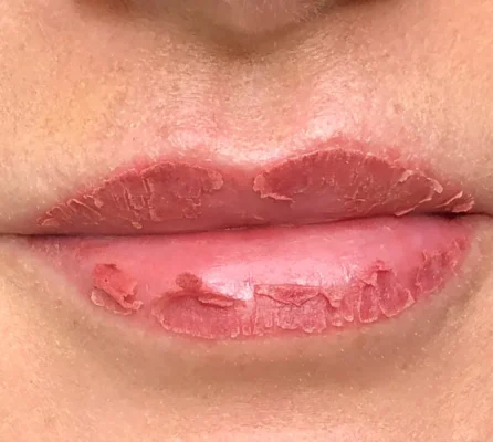 Phun môi 2 ngày đã bong có phải bị hỏng không? Cách xử lý