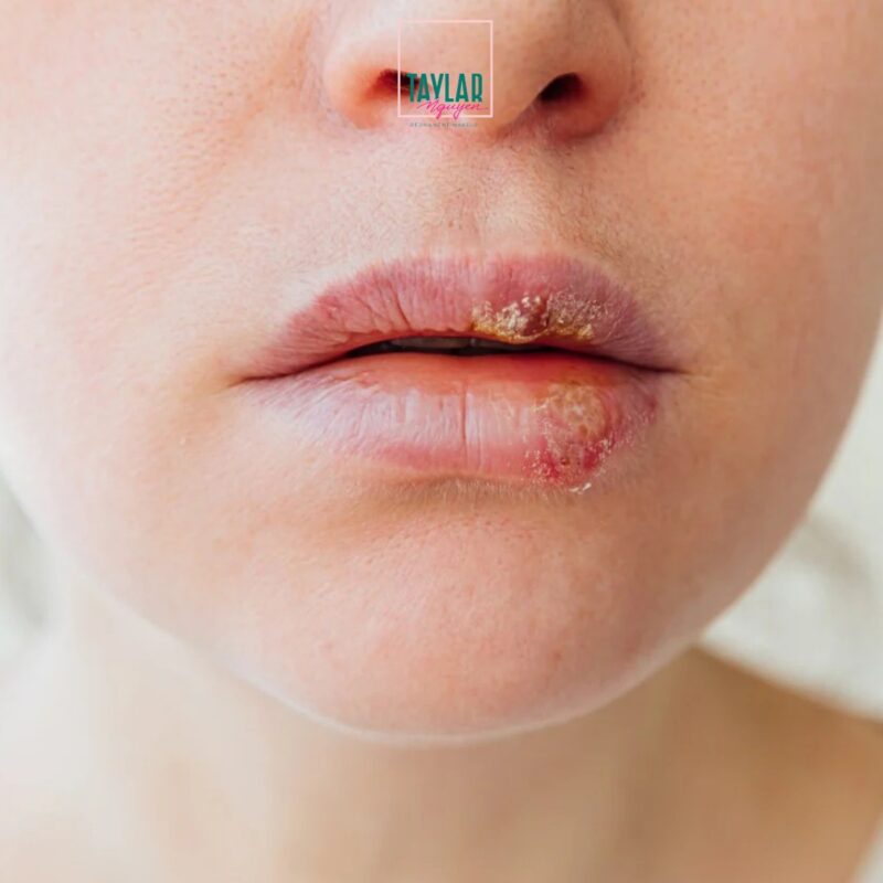 Tình trạng phun môi collagen bị nổi mụn nước